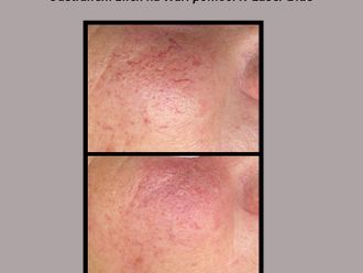 Laserová dermatologie před a po - 861163