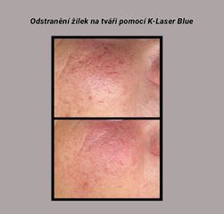 Laserová dermatologie - MUDr. Drahomíra Kotlářová