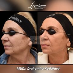 Facelift - MUDr. Drahomíra Kotlářová