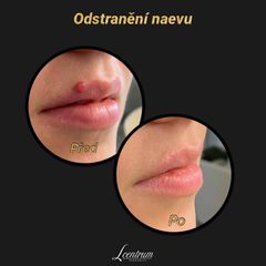 Laservá dermatologie - MUDr. Drahomíra Kotlářová