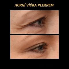 Operace horních víček - MUDr. Drahomíra Kotlářová