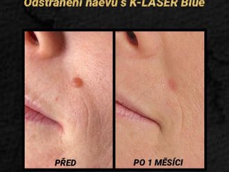 Laserová dermatologie před a po - 861168