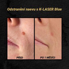 Laserová dermatologie - MUDr. Drahomíra Kotlářová