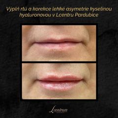 Zvětšení rtů kyselinou hyaluronovou - MUDr. Drahomíra Kotlářová