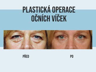 Operace očních víček před a po - 862017