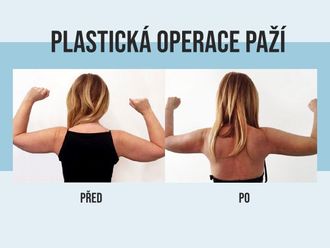 Plastická operace paží před a po - 862018