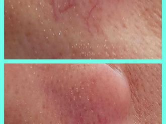 Laserová dermatologie - 856914