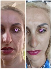 Neinvazivní lifting obličeje - PLATONOVA clinic