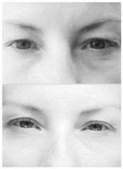 Laser Smooth Eye (rejuven.očniho okolí, víčka) - PLATONOVA clinic