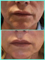 Laser rejuvenace + LipLase (širší okolí úst, brada, nasolab.vrasky) - PLATONOVA clinic
