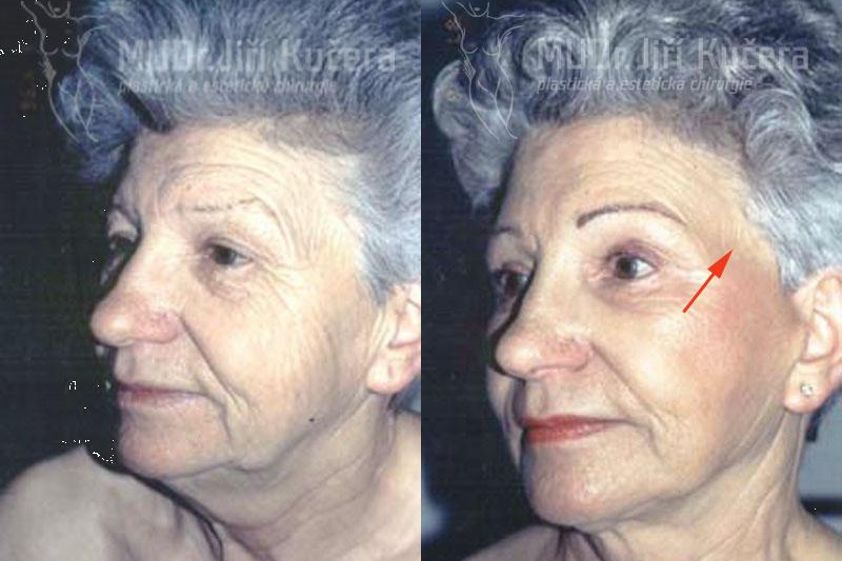 Brow lift před a po - 722537