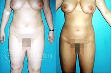 liposukce1maxi