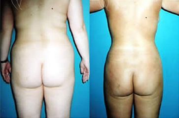 liposukce3maxi