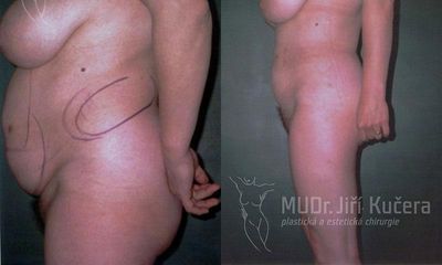 liposukce6pred maxi
