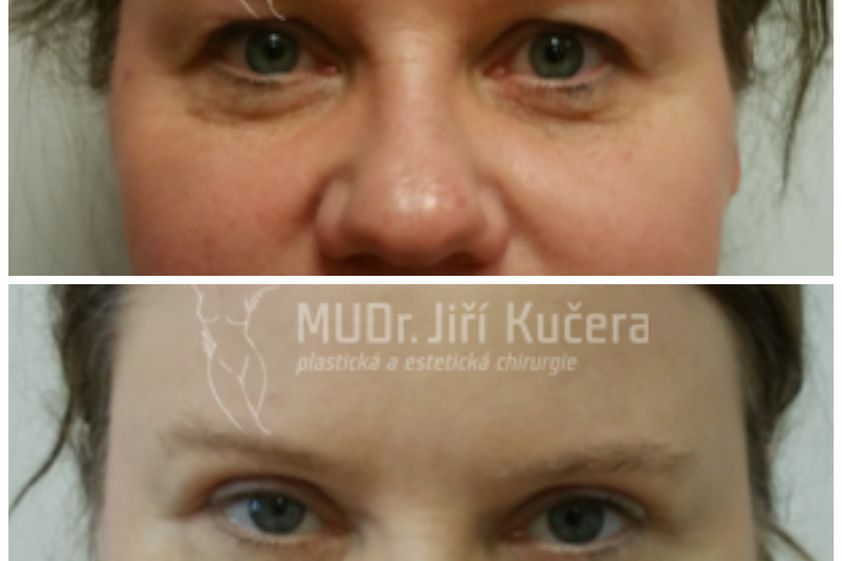 Brow lift před a po - 791439