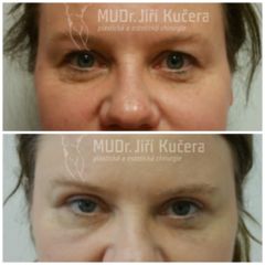 Brow Lift - MUDr. Jiří Kučera