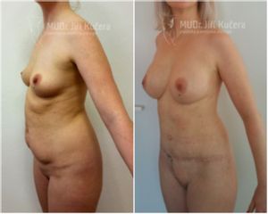 Abdominoplastika - MUDr. Jiří Kučera