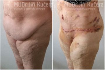 Abdominoplastika - MUDr. Jiří Kučera
