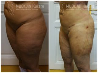 Liposukce - MUDr. Jiří Kučera