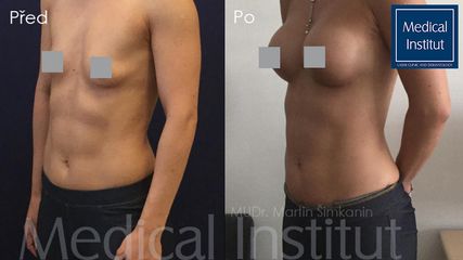 Zvětšení prsou - Medical Institut Care s.r.o.