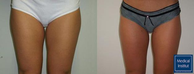 Lipo stehna - Medical Institut Care s.r.o.