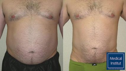 Liposukce - Medical Institut Care s.r.o.