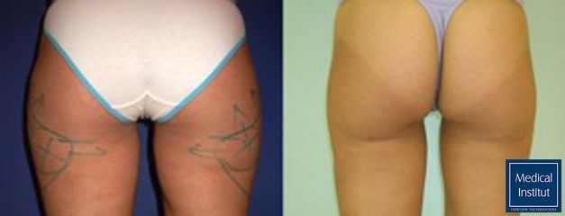 Liposukce - Medical Institut Care s.r.o.
