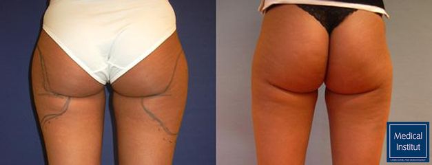Liposukce - Medical Institut Care s.r.o.