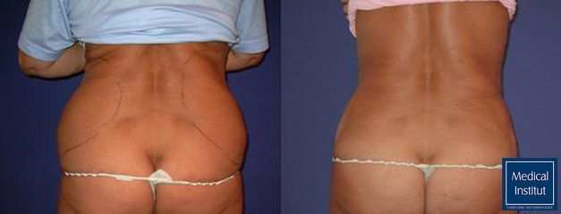 Liposukce - Medical Institut Care s.r.o.
