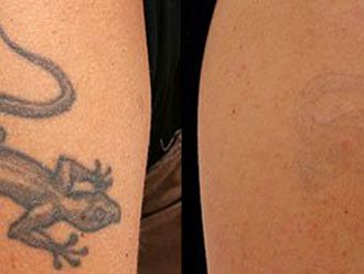 Odstranění tetování - 742600