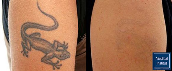Odstranění tetování - Medical Institut Care s.r.o.