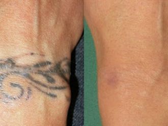 Odstranění tetování - 742601
