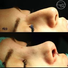 Rhinoplastika - Medical Institut Care s.r.o.