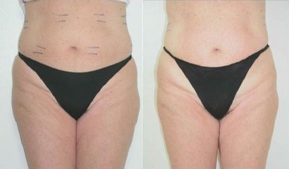 UltraShape