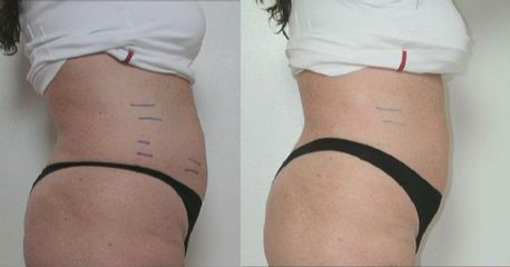 UltraShape