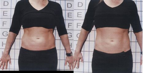 UltraShape