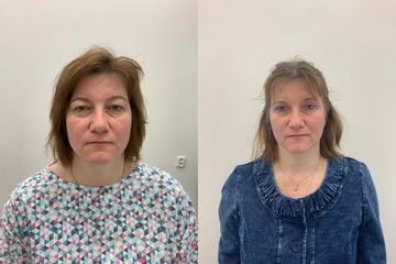 Blefaroplastika pred