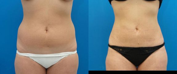 lipo2 bricho boky pred a
