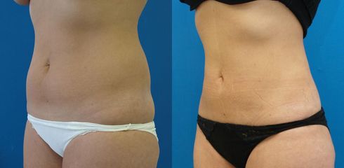 lipo2 bricho boky pred c