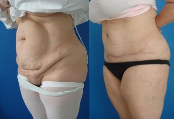 adominoplasty1 preda