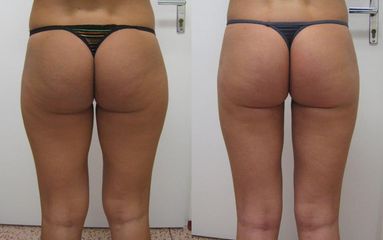 lipo3 stehna pred b