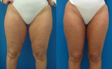 lipo4 stehna pred a