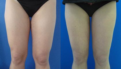 lipo5 stehna pred b