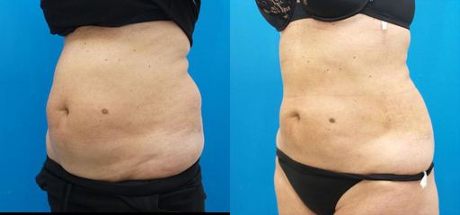 lipobricha predpo1pred kopie
