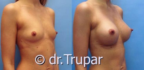 augmentace Trupar 7 0002