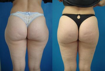 lipo1 zevni stehna pred b
