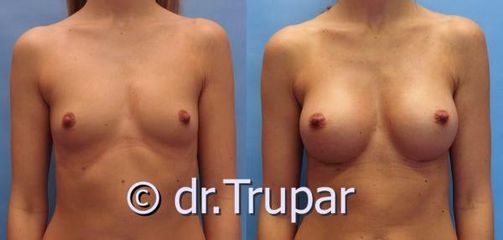 augmentace Trupar 7 0003