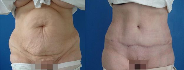 abdominoplastika MJ DSC03294 kopie