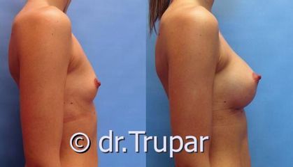 augmentace Trupar 7 0001
