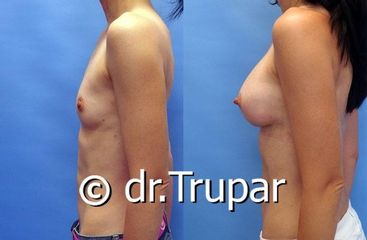 augmentace Trupar 1 0001